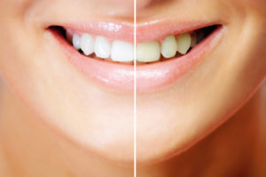  A smile before and after whitening
