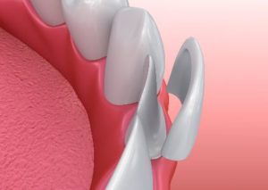 Illustration of a veneer being placed on a front tooth